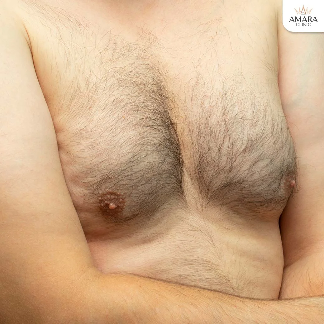 large nipples problems
